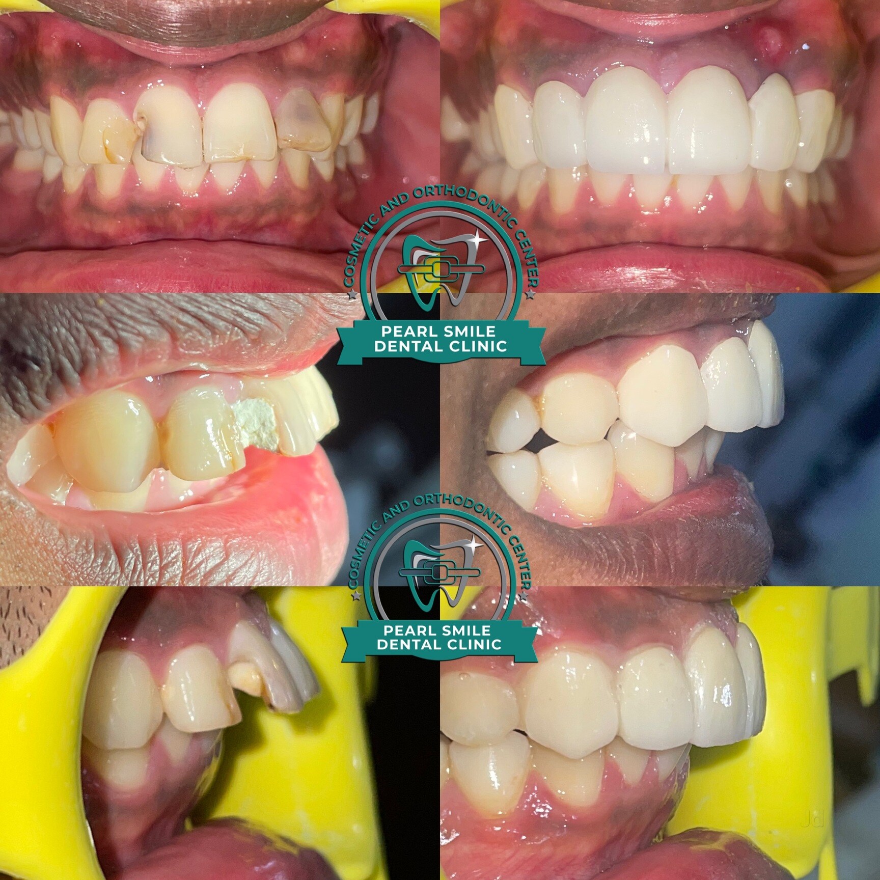 Root Canal Treatment