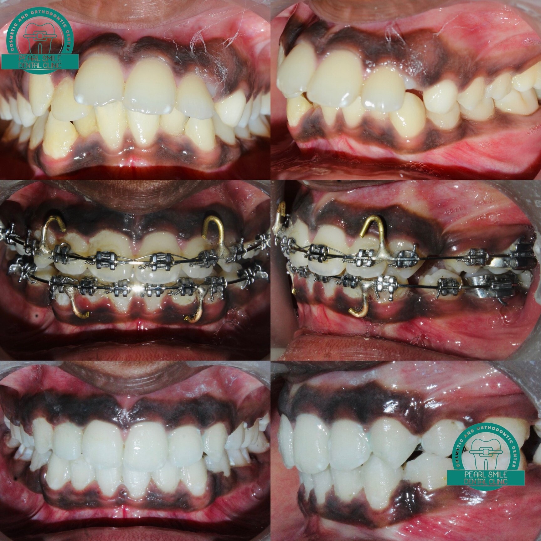 Root canal treatment