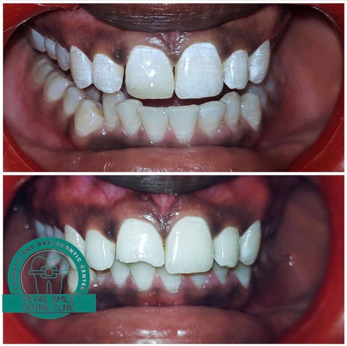 Open Bite Correction