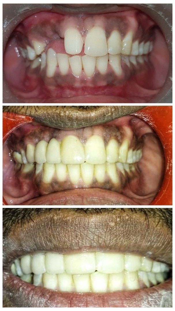 Tooth Gap Treatment